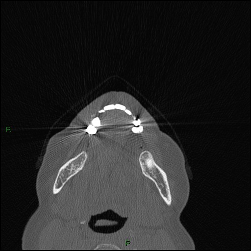 Bilateral frontal mucoceles (Radiopaedia 82352-96454 Axial bone window 296).jpg