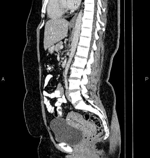 Bilateral ovarian dermoid cysts (Radiopaedia 85785-101603 D 49).jpg