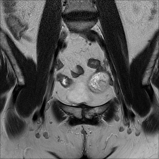 File:Bilateral ovarian dermoid cysts (Radiopaedia 90152-107338 Coronal T2 9).jpg