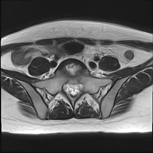 File:Bilateral ovarian endometriomas (Radiopaedia 87085-103347 Axial T2 1).jpg