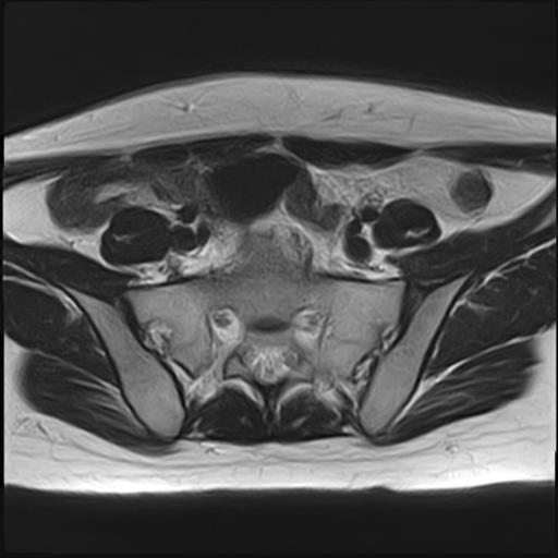 File:Bilateral ovarian endometriomas (Radiopaedia 87085-103347 Axial T2 3).jpg
