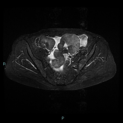 File:Bilateral ovarian fibroma (Radiopaedia 44568-48293 Axial STIR 11).jpg