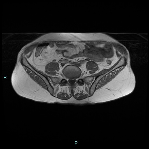 File:Bilateral ovarian fibroma (Radiopaedia 44568-48293 Axial T1 2).jpg
