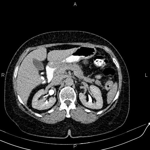 Bilateral ovarian serous cystadenocarcinoma (Radiopaedia 86062-101989 Axial C+ delayed 16).jpg