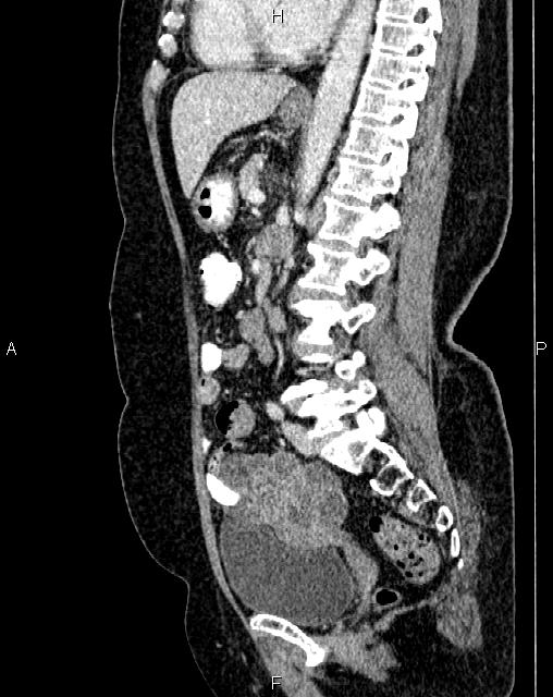Bilateral ovarian serous cystadenocarcinoma (Radiopaedia 86062-101989 E 48).jpg