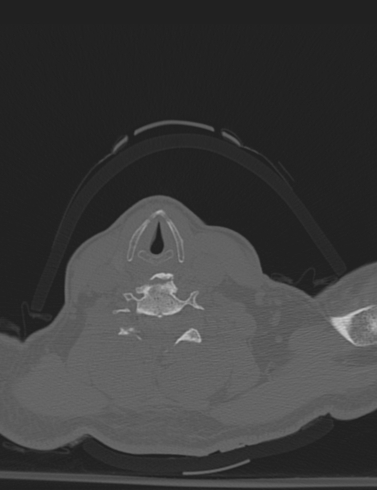 Bilateral perched facet joint (Radiopaedia 63149-71669 Axial bone window 45).jpg