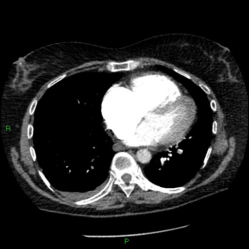 Bilateral pulmonary emboli (Radiopaedia 32700-33669 Axial C+ CTPA 72).jpg