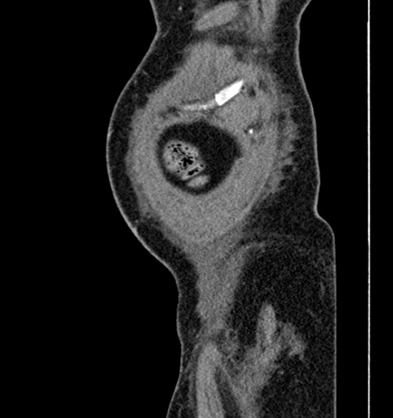 Bilateral rectus sheath hematomas (Radiopaedia 50778-56252 B 6).jpg