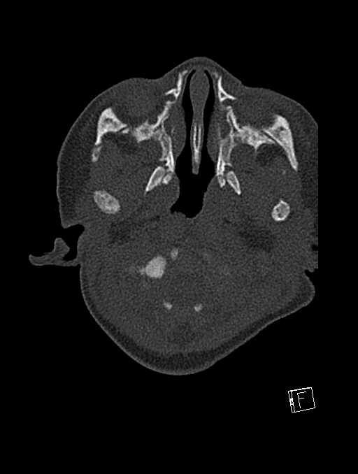 Bilateral subdural hemorrhage and parietal skull fracture (Radiopaedia 26058-26192 Axial bone window 120).png