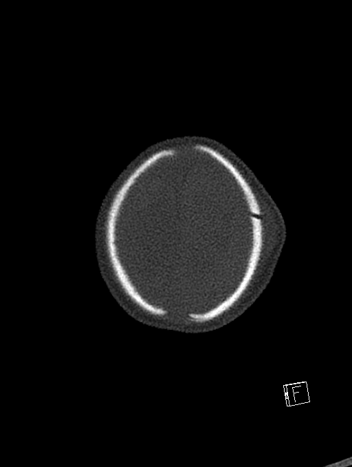 Bilateral subdural hemorrhage and parietal skull fracture (Radiopaedia 26058-26192 Axial bone window 9).png