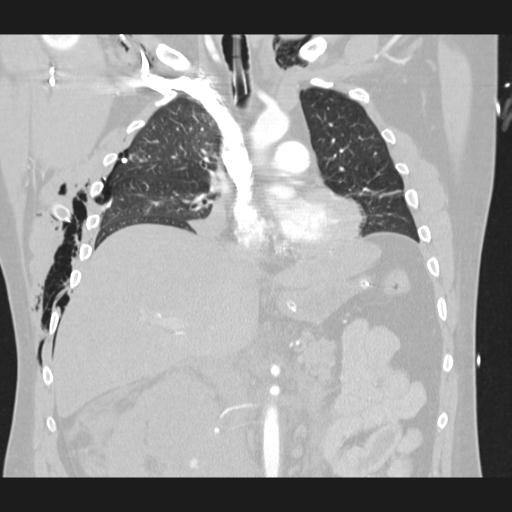 Bilateral traumatic renovascular injury (Radiopaedia 32051-32995 Coronal lung window 38).jpg