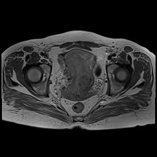 Bilateral tubo-ovarian abscesses (Radiopaedia 58635-65829 Axial T1 C+ 33).jpg