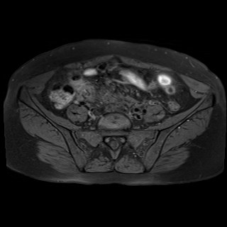 Bilateral tubo-ovarian abscesses (Radiopaedia 58635-65829 Axial T1 fat sat 5).jpg