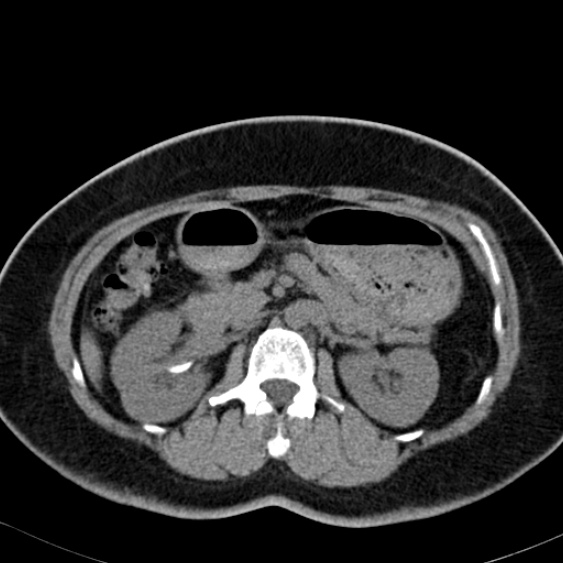 Bilateral ureteric stents (Radiopaedia 48795-53825 Axial non-contrast 21).jpg