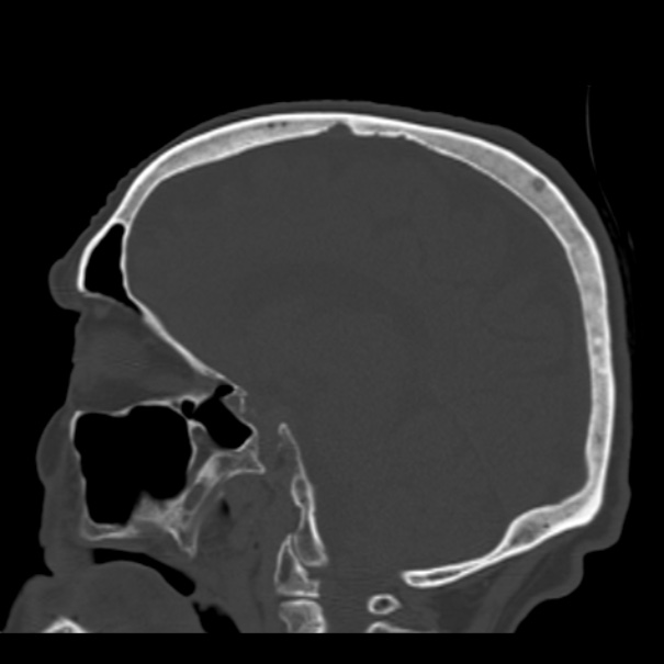 Biparietal osteodystrophy (Radiopaedia 46109-50463 Sagittal bone window 46).jpg