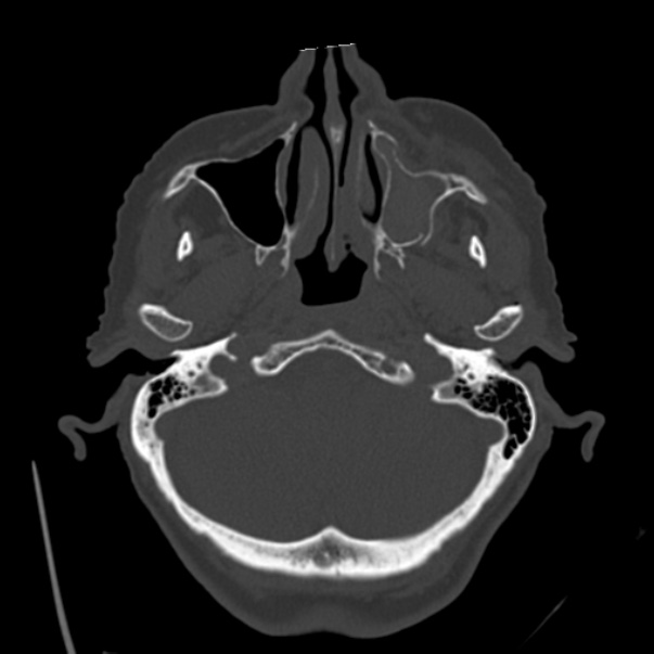 Biparietal osteodystrophy (Radiopaedia 46109-50463 bone window 14).jpg