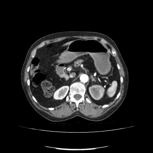File:Bladder tumor detected on trauma CT (Radiopaedia 51809-57609 A 93).jpg