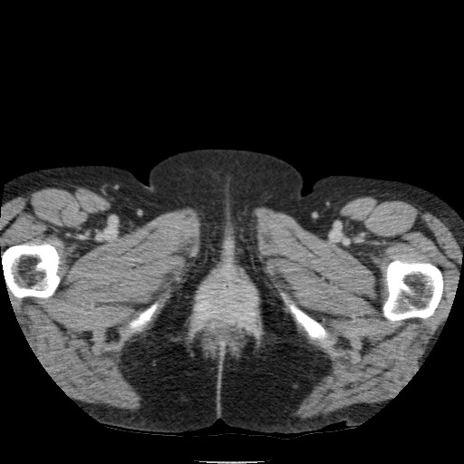 Bladder tumor detected on trauma CT (Radiopaedia 51809-57609 C 152).jpg