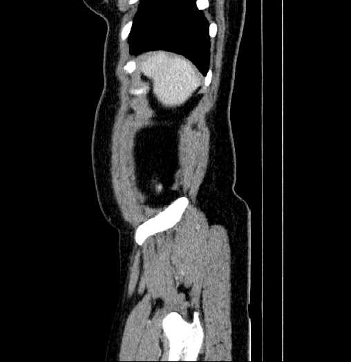 Blind-ending branch of a bifid ureter (Radiopaedia 61159-69048 B 1).jpg