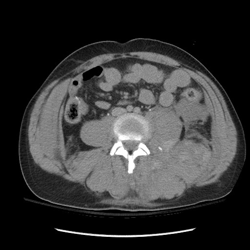 Blunt abdominal trauma with solid organ and musculoskelatal injury with active extravasation (Radiopaedia 68364-77895 Axial C+ delayed 83).jpg