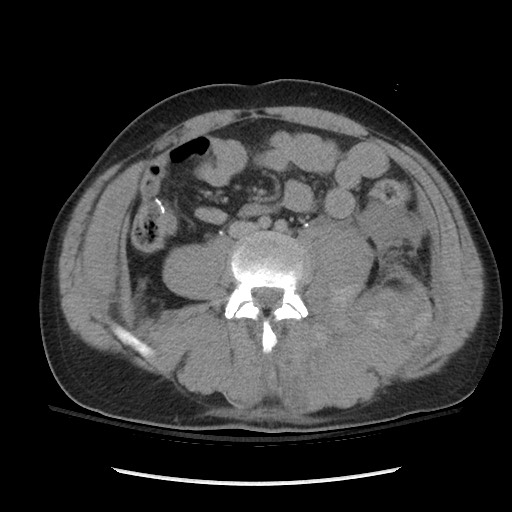 Blunt abdominal trauma with solid organ and musculoskelatal injury with active extravasation (Radiopaedia 68364-77895 Axial C+ delayed 84).jpg