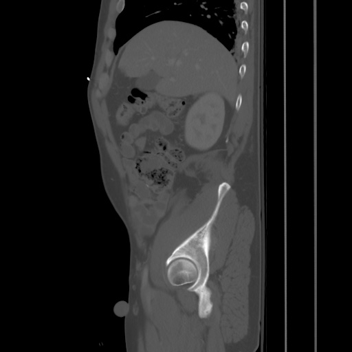 Blunt abdominal trauma with solid organ and musculoskelatal injury with active extravasation (Radiopaedia 68364-77895 Sagittal bone window 21).jpg