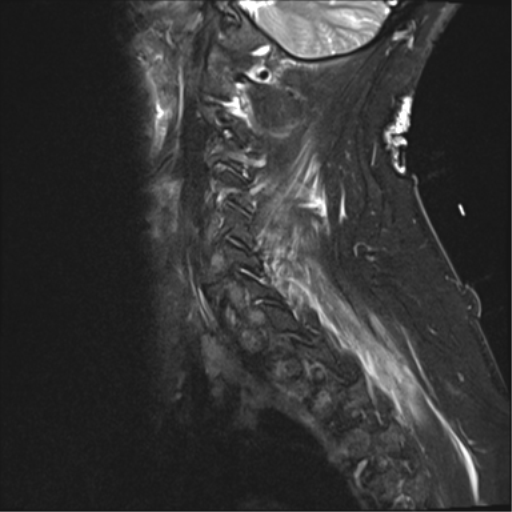 File:Blunt cerebrovascular injury (Radiopaedia 53682-59744 Sagittal T2 fat sat 1).png