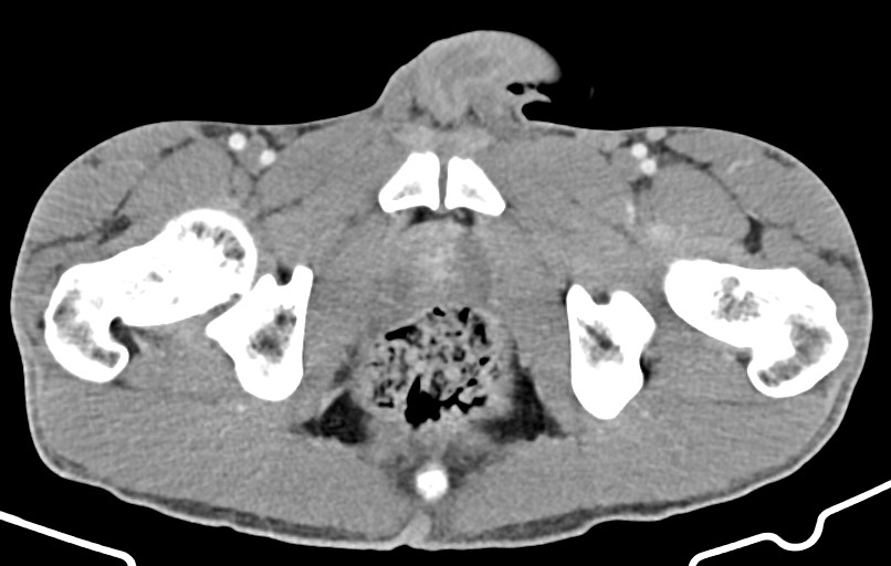 Blunt injury to the small bowel (Radiopaedia 74953-85987 A 195).jpg