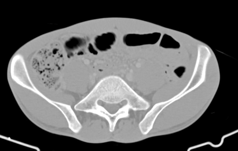 Blunt injury to the small bowel (Radiopaedia 74953-85987 Axial Wide 68).jpg