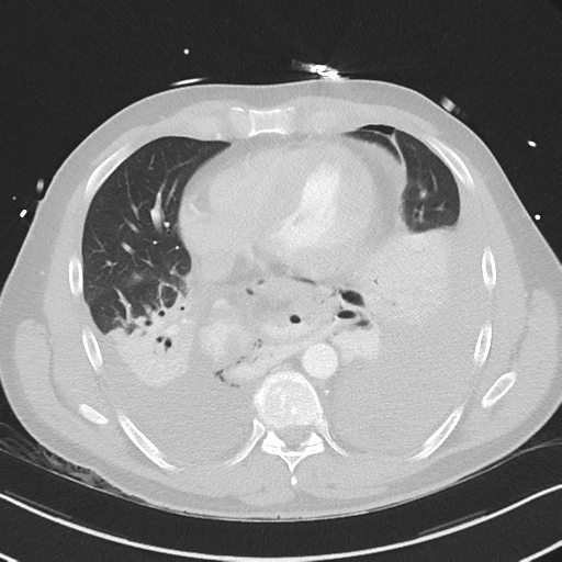 Boerhaave syndrome (Radiopaedia 39382-41661 Axial lung window 37).png