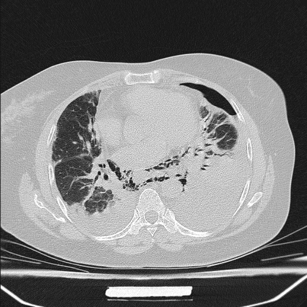 Boerhaave syndrome (Radiopaedia 45644-49799 Axial lung window 72).jpg