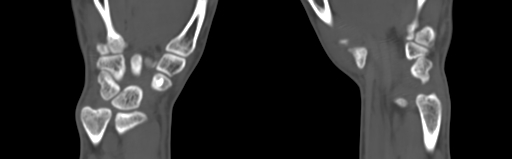 File:Bone islands - carpus (Radiopaedia 63141-71658 Coronal bone window 51).jpg