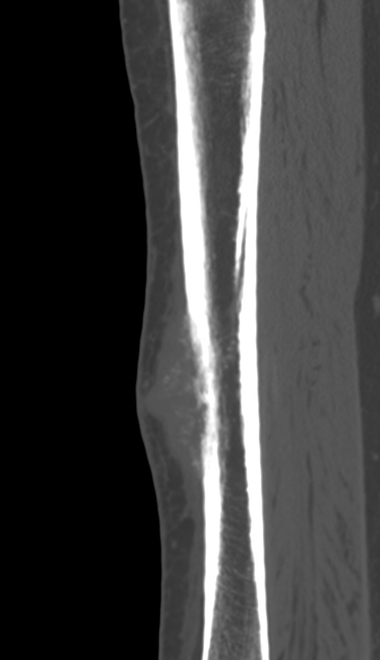 Bone metastasis - tibia (Radiopaedia 57665-64609 Sagittal bone window 73).jpg