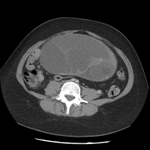 File:Borderline mucinous tumor (ovary) (Radiopaedia 78228-90808 A 100).jpg
