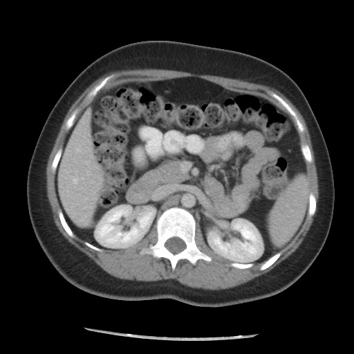 File:Borderline mucinous tumor (ovary) (Radiopaedia 78228-90808 A 81).jpg