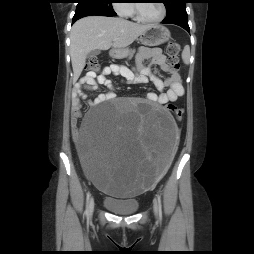 Borderline mucinous tumor (ovary) (Radiopaedia 78228-90808 C 21).jpg