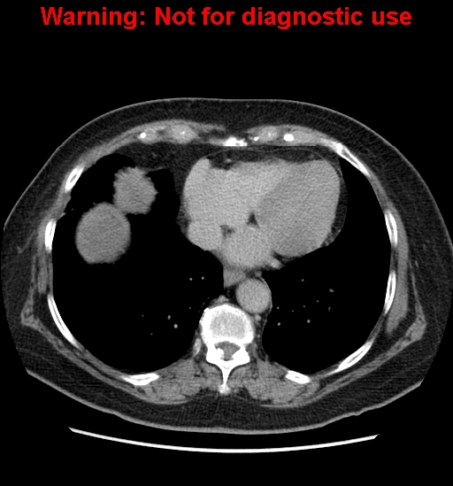 File:Bosniak renal cyst - type II (Radiopaedia 23404-23468 F 4).jpg