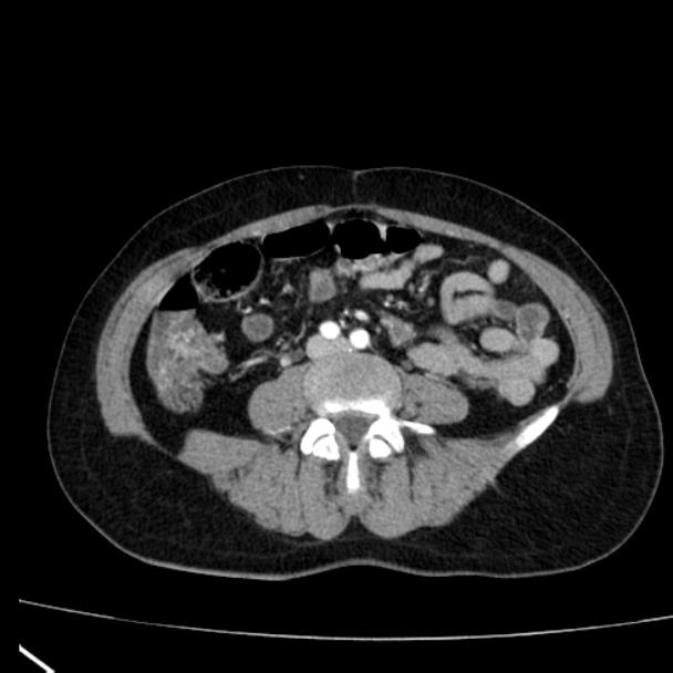 Bosniak renal cyst - type I (Radiopaedia 27479-27675 renal cortical phase 56).jpg