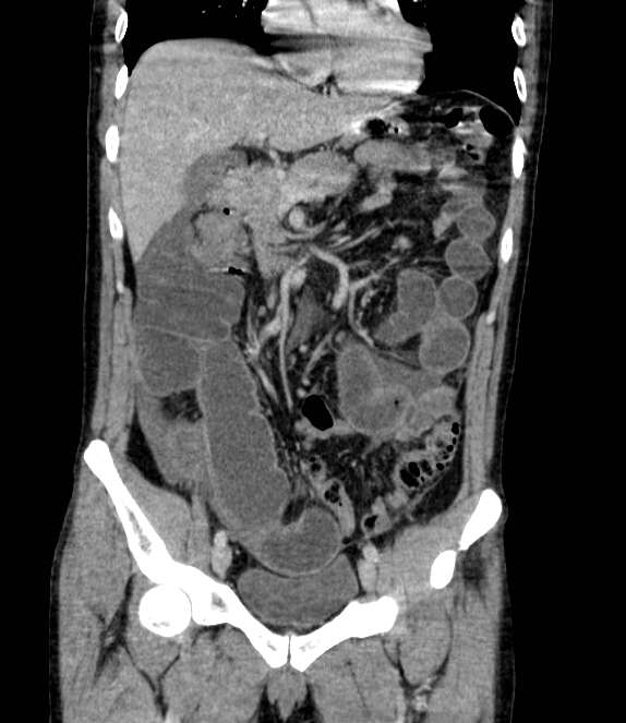 Bowel obstruction from colon carcinoma (Radiopaedia 22995-23028 C 30).jpg