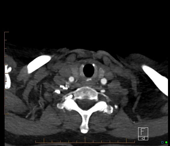 Brachiocephalic trunk stenosis (Radiopaedia 87242-103519 A 115).jpg