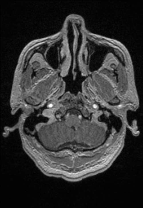 Brain abscess with ventriculitis (Radiopaedia 85703-101495 Axial T1 C+ 31).jpg