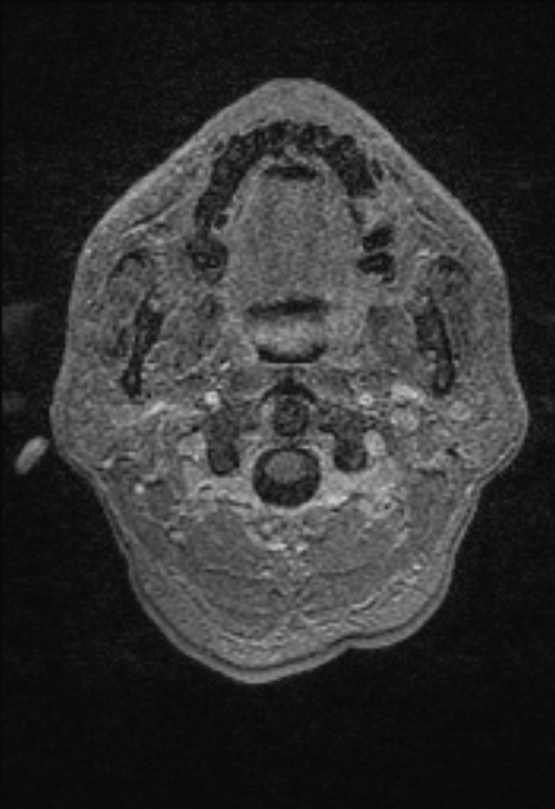 Brain abscess with ventriculitis (Radiopaedia 85703-101495 Axial T1 C+ 5).jpg