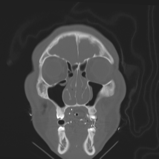 Brain contusions, internal carotid artery dissection and base of skull fracture (Radiopaedia 34089-35339 Coronal bone window 17).png