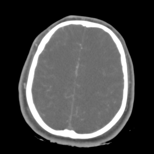 Brain contusions, internal carotid artery dissection and base of skull fracture (Radiopaedia 34089-35339 D 15).png