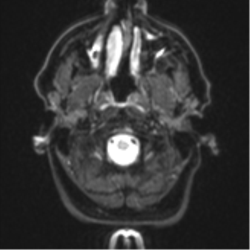 Brain metastasis (large cystic mass) (Radiopaedia 47497-52107 Axial DWI 1).png