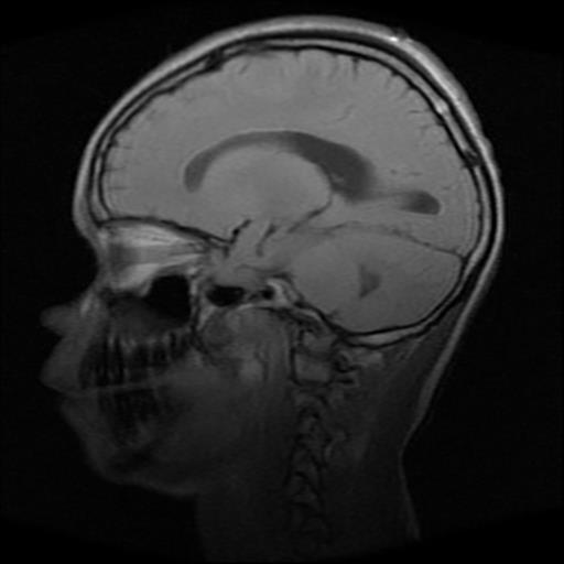 File:Brainstem glioma (Radiopaedia 30923-31624 Sagittal T1 7).jpg