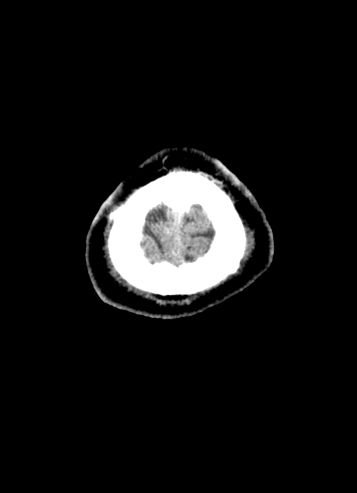 Brainstem hemorrhage (Radiopaedia 81294-94976 Axial non-contrast 5).jpg
