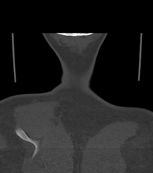 Branchial cleft cyst (Radiopaedia 31167-31875 Coronal bone window 64).jpg