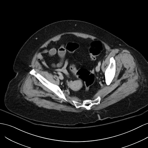 Breast carcinoma with pathological hip fracture (Radiopaedia 60314-67974 B 60).jpg