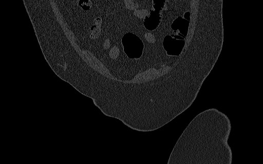 File:Breast carcinoma with pathological hip fracture (Radiopaedia 60314-67993 Coronal bone window 34).jpg